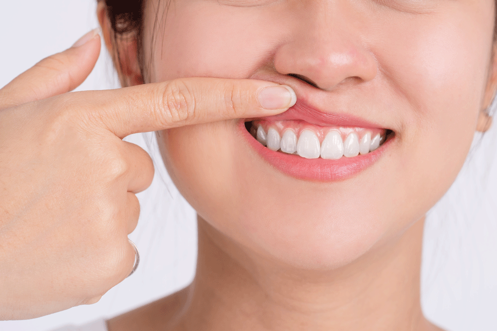 Gum Grafts