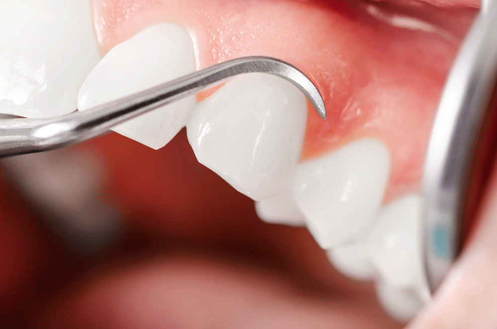 Gum Grafts