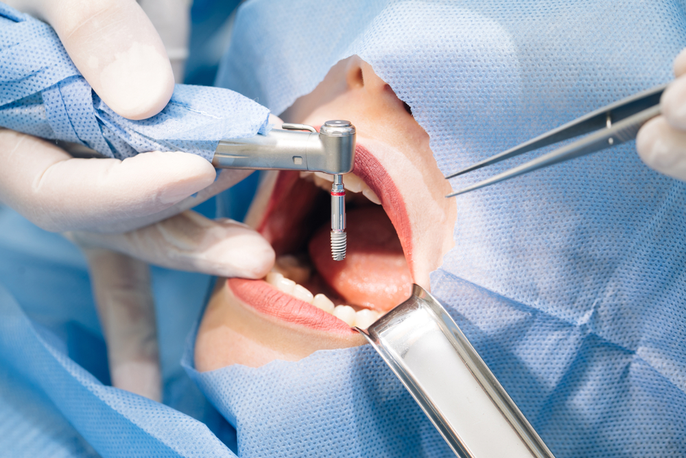 Root Canal Therapy