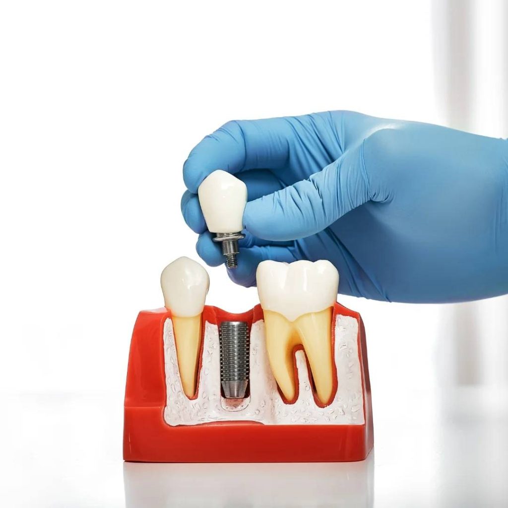 Implant Dentistry in Dorchester, ON