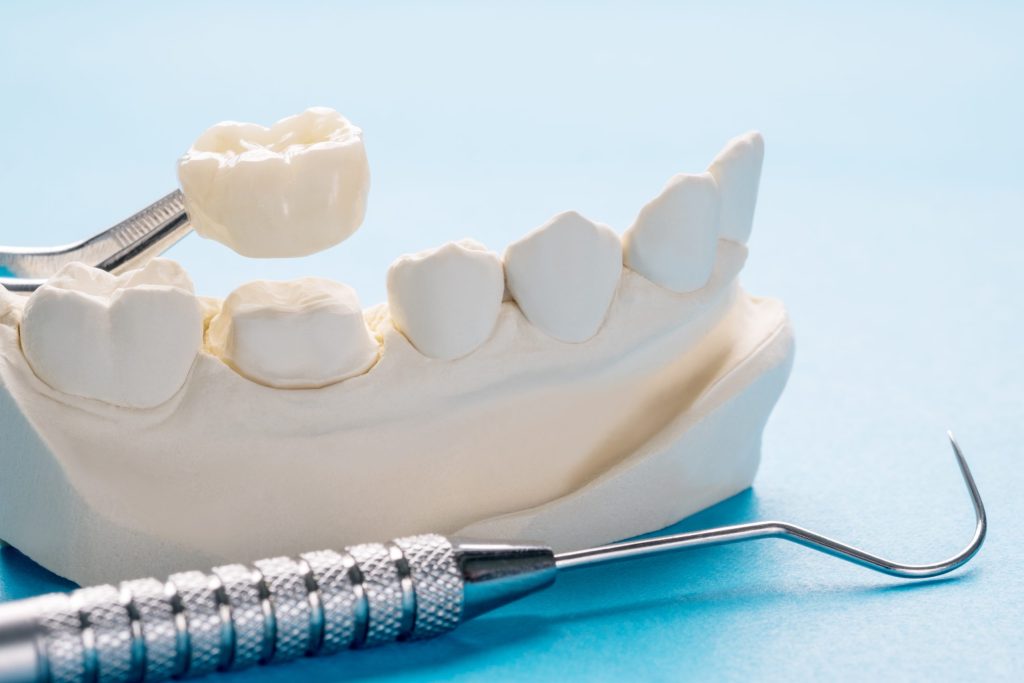 Model of a dental crown and bridge with a dental probe