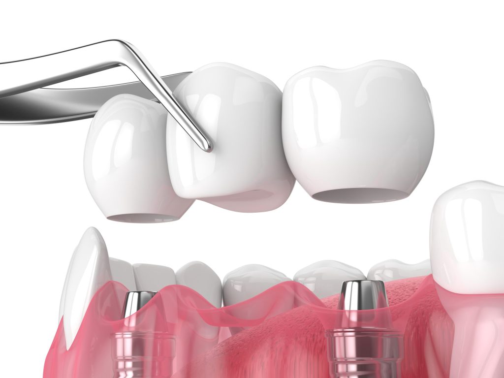 Illustration of a dental bridge supported by implants