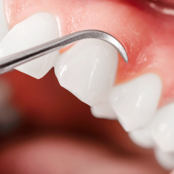Gum Grafts