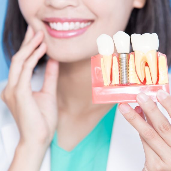 Dental-Implants-scaled.jpeg