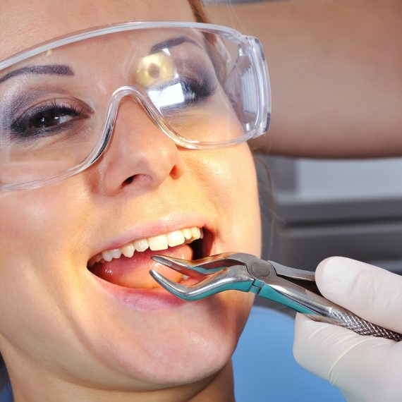 Wisdom-Teeth-Extraction.jpg
