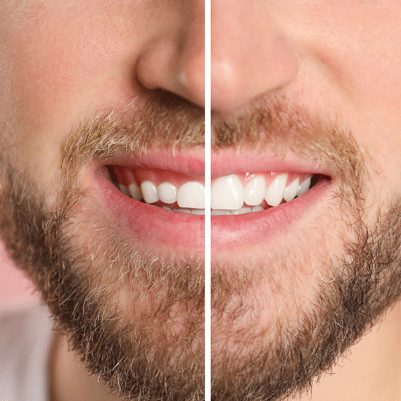 Gum Contouring