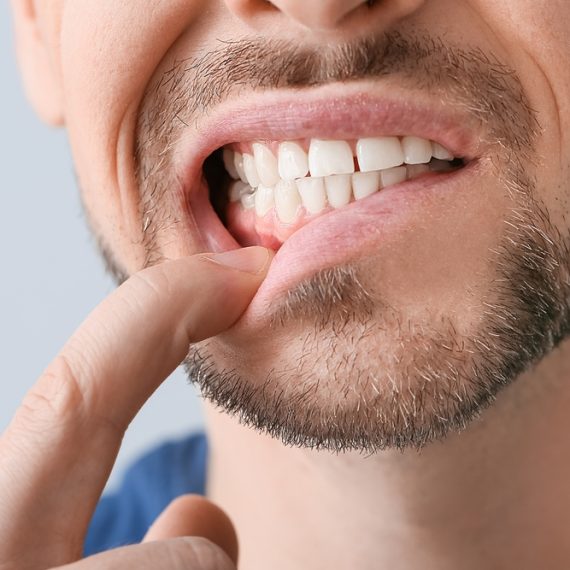 Gingivectomy