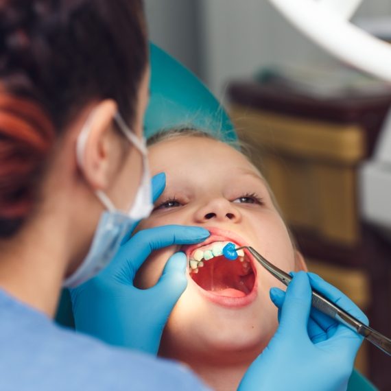 Fluoride Treatments
